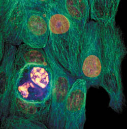 [2] Раковые клетки. David Becker/The Wellcome Trust. Confocal image.